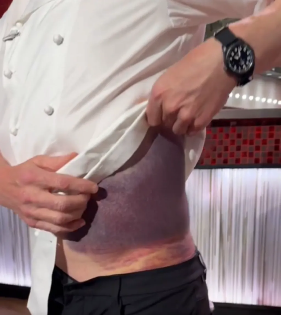 Gordon Ramsey’s Bike accident: A Celebrity chef reveals consequences of shocking incident